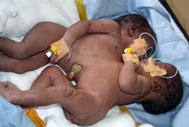 Conjoined twins now have pneumonia