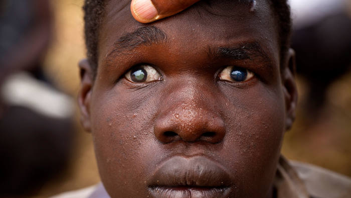 Uganda to eliminate river blindness by 2020