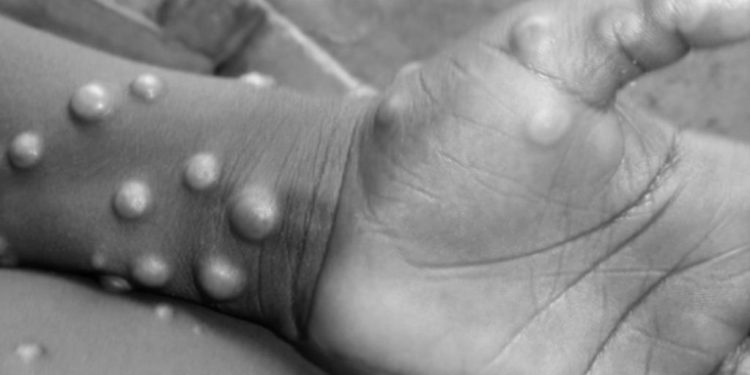 WHO okays 3 Ugandan labs, donates monkeypox test kits