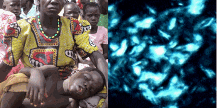 Over 1,700 estimated to be suffering from nodding disease in Acholi