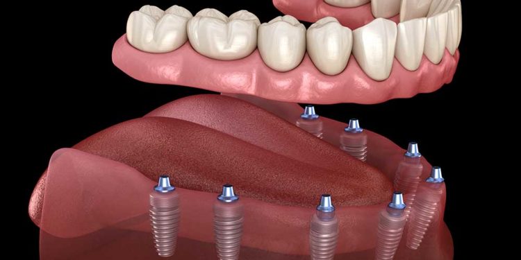 The Advantages of Getting Dental Implants in Turkey as a Dental Tourist