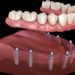 The Advantages of Getting Dental Implants in Turkey as a Dental Tourist