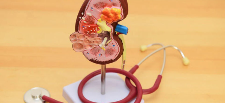 Health experts outline key drivers of kidney failure