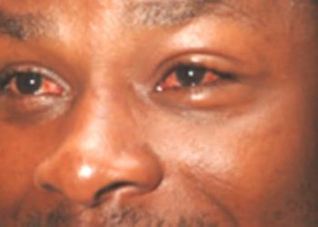 KCCA confirms red eye disease outbreak in Kampala schools