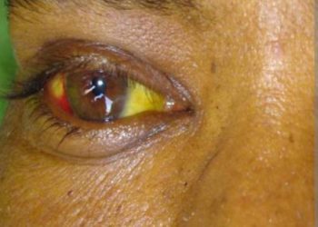 Contact-tracing intensified following confirmation of Rift Valley Fever death in Mubende