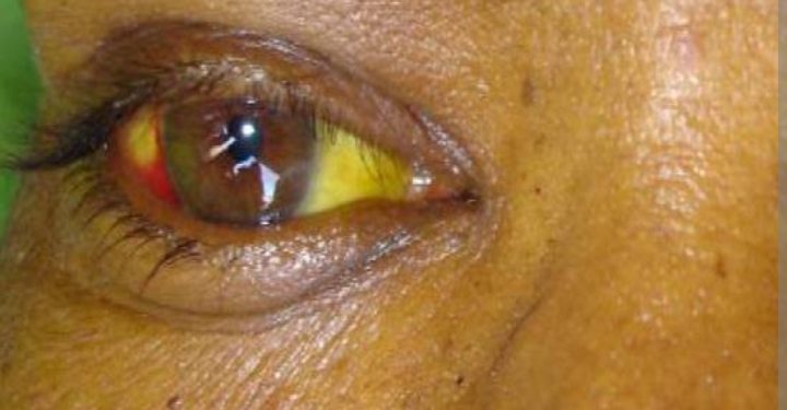 Contact-tracing intensified following confirmation of Rift Valley Fever death in Mubende