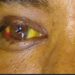 Contact-tracing intensified following confirmation of Rift Valley Fever death in Mubende
