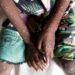 WHO raises Mpox response to highest levels in Africa