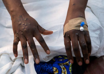 Mpox cases on African continent show 500% increase year-on-year
