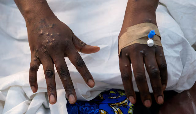 Mpox cases on African continent show 500% increase year-on-year