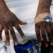 Mpox cases on African continent show 500% increase year-on-year